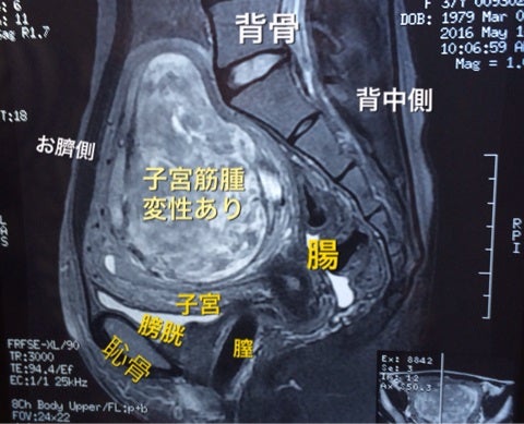 子宮筋腫 Mri 手術方法を考える こまめのブログ