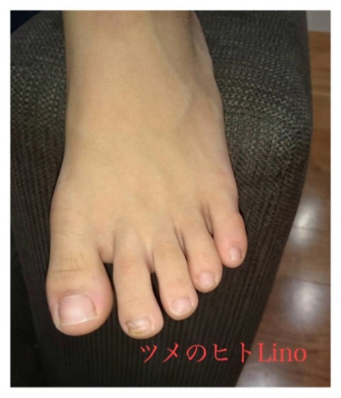 サッカー少年の足と爪 Lino