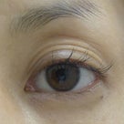 目の上のくぼみにヒアルロン酸を入れ続けると重くなるのかの記事より