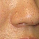 鼻中隔延長術：Ｌ型プロテーゼ抜去後に鼻先が低くなってしまったケースの修正の記事より