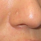 鼻中隔延長術：Ｌ型プロテーゼ抜去後に鼻先が低くなってしまったケースの修正の記事より