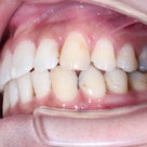 22歳　男性　凸凹が主訴　上下前歯を抜歯しての治療が終了しました。の記事より