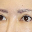 ４０代女性、「眉下切開法」手術後３ヶ月目の変化をご紹介します。の記事より