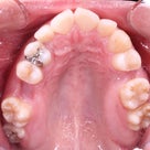 23歳　女性　上顎犬歯の埋伏や残根歯、凸凹が主訴　犬歯や残根抜歯して治療終了しました。の記事より