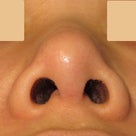 鼻尖形成術：術後6ヶ月　鼻先がやわらかく 　しびれ感なし　 オープン法のキズ痕（きずあと）の記事より