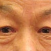 眼瞼下垂　2か月半の画像