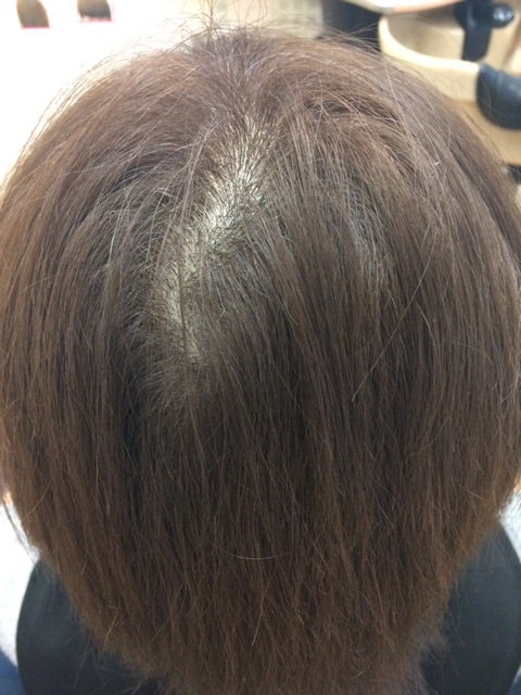 50代 女性の薄毛 つむじ割れが 札幌市エクステ増毛サロン Mix Hair Accel アクセル
