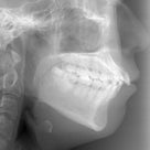 26歳　女性　上顎前突・凸凹が主訴　小臼歯4本抜歯にて治療が終了しました。の記事より