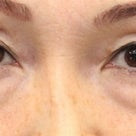 ５０代女性「切らない目の下のたるみ取り+リデンシティⅡ」手術後２ヶ月目の変化です。の記事より
