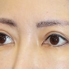 ４０代女性、「眉下切開法」手術後３ヶ月目の変化をご紹介します。の記事より