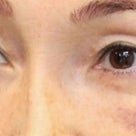 ５０代女性「切らない目の下のたるみ取り+リデンシティⅡ」手術後２ヶ月目の変化です。の記事より
