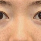 3０代女性「切らない目の下のたるみ取り+リデンシティⅡ」手術後６ヶ月目の経過です。の記事より