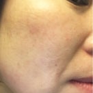 ソウル女子旅'17春〜ウテハ皮膚科でシミを取って綺麗になろう！！〜の記事より