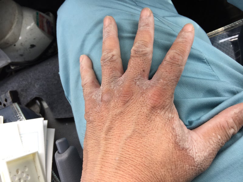 指定難病の掌蹠角化症と魚鱗癬 D Hiroshiのブログ