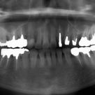 50歳　女性　凸凹が主訴　小臼歯2本抜歯の治療が終了しました。の記事より