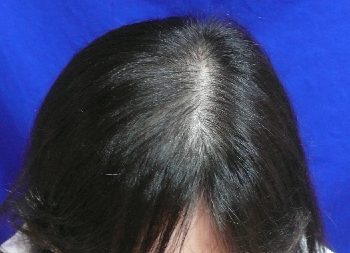 症例写真！！女性の薄毛治療！！ すっぴん女医 Dr.CHIHOの美容ブログ