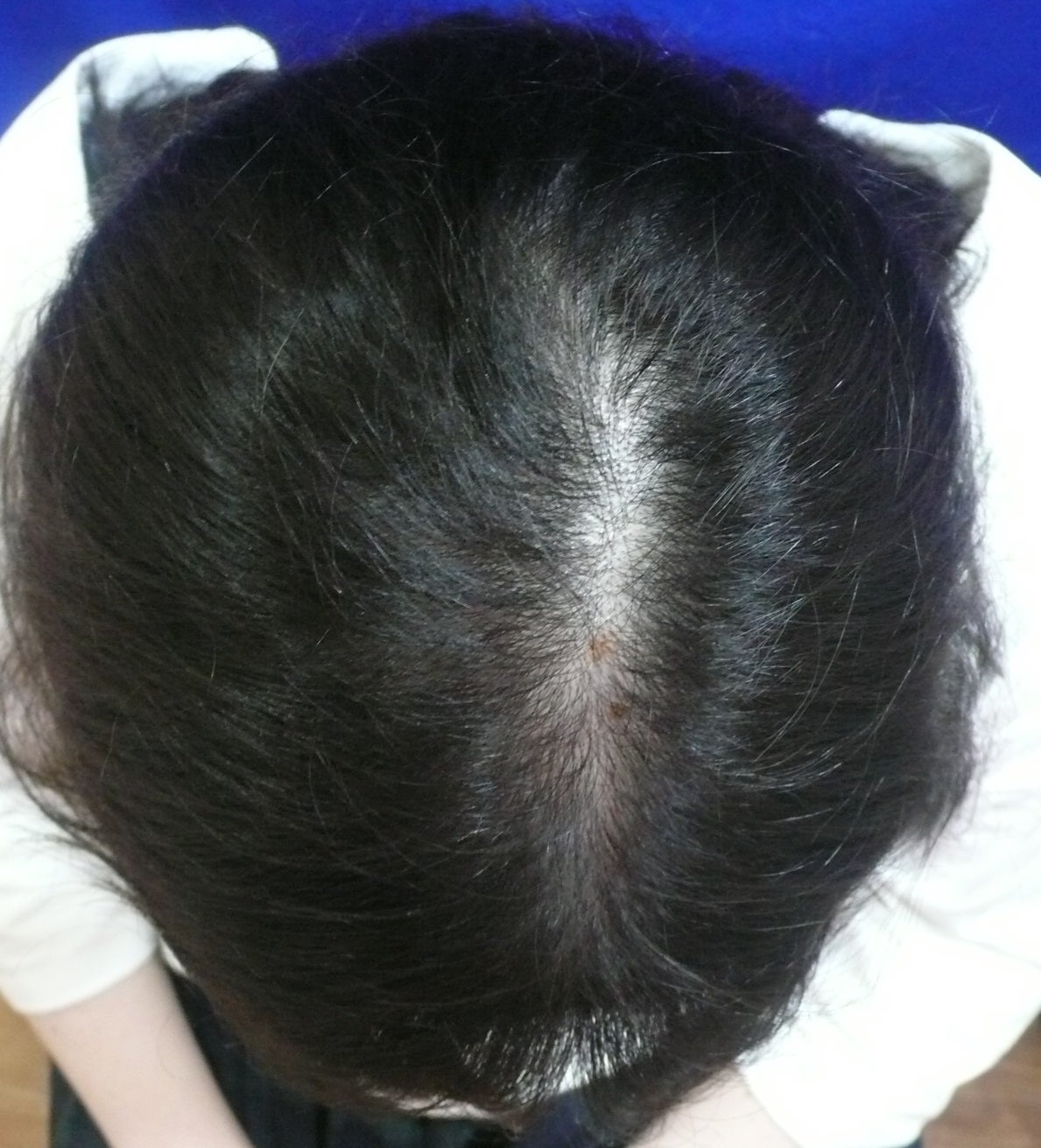 症例写真！！女性の薄毛治療！！ すっぴん女医 Dr.CHIHOの美容ブログ