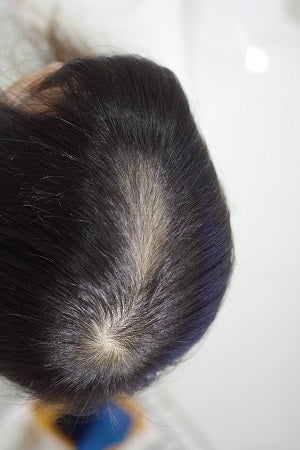 ダメージヘア改善・抜毛症改善はビョウインからビヨウインの時代へ／抜毛症に伴う、うつ・不登校・引きこもりを改善八年続いた抜毛症がわずか４か月半で。。。
