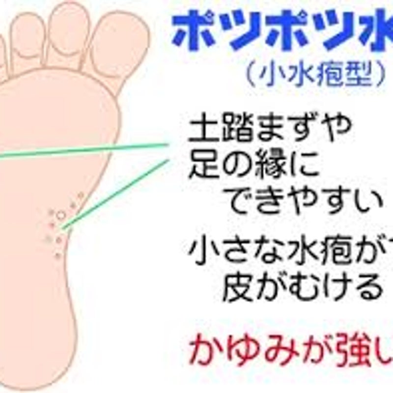 皮 が むける 足 水虫 以外 の 手や足のブツブツ・皮むけ（汗疱、掌蹠膿疱症）
