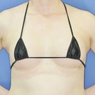4０代女性「Motiva（モティバ）エルゴノミクス豊胸術」手術後１ヶ月目の変化です。の記事より