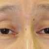眼瞼下垂に対する腱膜固定術　４か月の画像