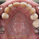 31歳　女性　凸凹と受け口が主訴　小臼歯3本抜歯での治療が終了しました。の記事より