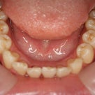 インビザラインの治療　前歯の凸凹の記事より