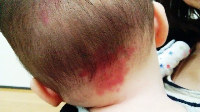 赤ちゃんの首の後ろの赤いアザ 赤ちゃん育児の専門家