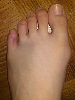 小指 た の 痛い ぶつけ 足 足の小指をドアに思いっきりぶつけてしまいました。よくある事なので、普段ならすぐ痛みは治ま…