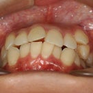 前歯が凸凹で八重歯もあります。の記事より
