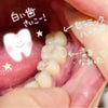 奥歯のトラブル【完結編】の画像