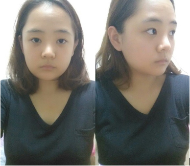 老け顔 エラ削り顔からかわいい韓国オルチャンになれる 韓国美容整形外科ならここ View美容外科
