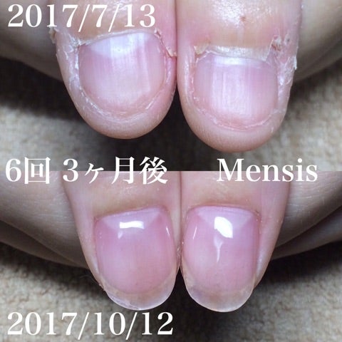 深爪矯正 3ヶ月後 734 恵比寿 爪悩み改善ネイルサロン Mensis Nail Salon