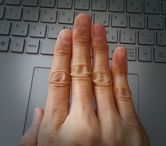 女性の月経前症状の重さ、「指の長さ」と相関関係？ コウノトリよ、ありがとう♪♪