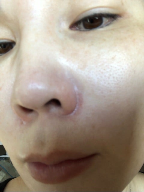 小鼻の赤みにプロトピック軟膏 梶田尚美オフィシャルブログ Dr 703の休診時間 Powered By Ameba