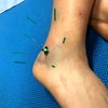 足関節の捻挫の画像