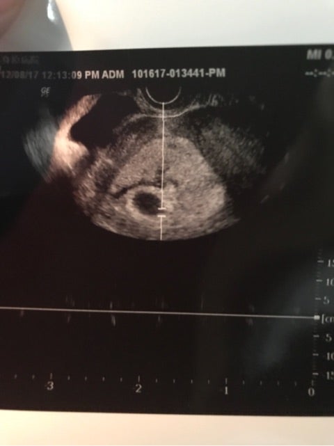 妊娠 初期 出血 茶色 6 週