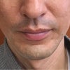 男性の顎のヒアルロン酸　前→後の画像