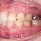 26歳　女性　受け口が主訴　上顎犬歯前歯計3本欠損で、大臼歯2本と前歯1本抜歯した症例の記事より