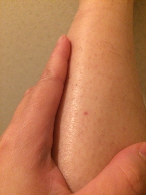 ブツブツ 足 赤い 足に赤い斑点ができた！かゆくないときの病気は？