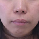 35歳　女性　上顎前突＆咬めない　が主訴　小臼歯4本親知らず2本抜歯で治療しました。の記事より