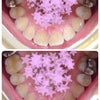 インレーポロリ。歯の大切さを再確認の画像