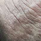 アトピーと免疫と皮膚の関係。アトピーがグレーになったら免疫は？  ｂｙなるりえの記事より