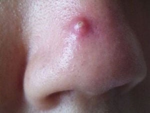 赤い もの 鼻 でき めんちょうが鼻に出来る原因は？症状や治療方法を紹介！