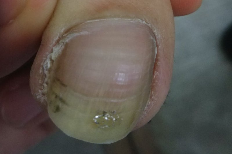 巻き爪専門センターのブログ爪棘がある、大きい爪の巻き爪