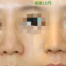画像 鼻プロテーゼの入れ替え の記事より 1つ目