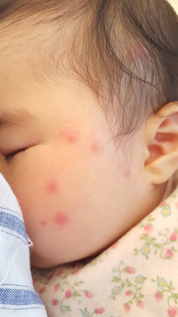 蚊に刺された 生後5ヶ月 Rie Aoki Blog