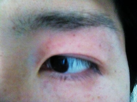 目 の 周り 赤い 斑点 目の周りが赤い３つの原因 かゆいし斑点があるような