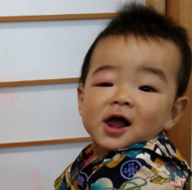 赤ちゃん 目 が 腫れる 子供の目が腫れる！小児科か眼科を受診しよう【画像あり】2才の次女の瞼がパンパンになった時の体験と経過。