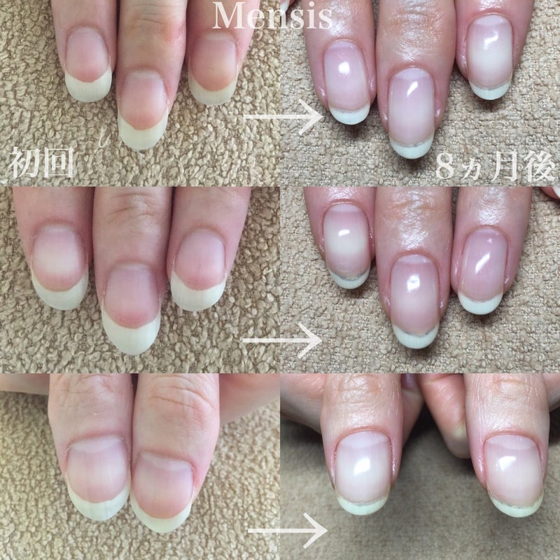 爪のピンクの部分を伸ばすなら 恵比寿メンシスネイルで 深爪矯正 727 恵比寿 爪悩み改善ネイルサロン Mensis Nail Salon